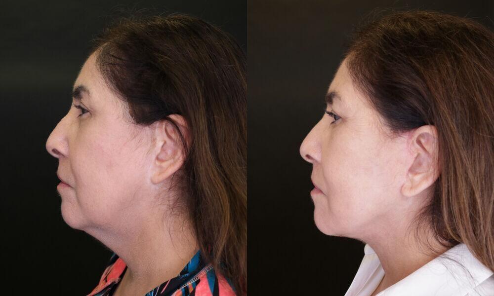 Jose Rodríguez-Feliz, MD neck lift result — Coral Gables, FL