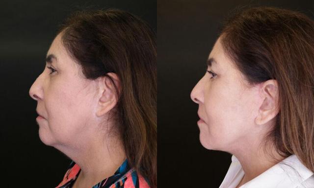 Neck Lift result at Jose Rodríguez-Feliz, MD in Coral Gables, FL