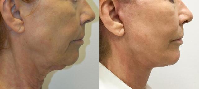 Neck Lift result at Jose Rodríguez-Feliz, MD in Coral Gables, FL