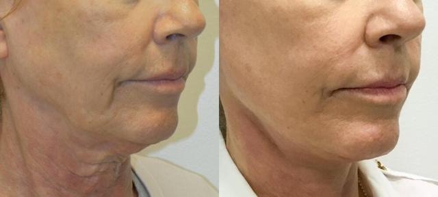 Neck Lift result at Jose Rodríguez-Feliz, MD in Coral Gables, FL