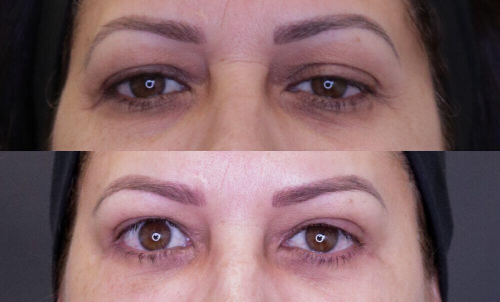 Jose Rodríguez-Feliz, MD blepharoplasty result — Coral Gables, FL