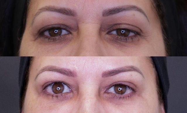 Blepharoplasty result at Jose Rodríguez-Feliz, MD in Coral Gables, FL