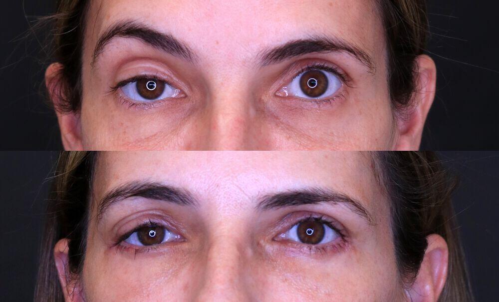 Jose Rodríguez-Feliz, MD blepharoplasty result — Coral Gables, FL