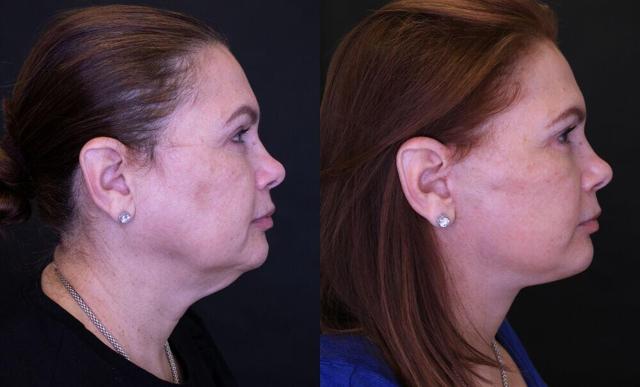 Neck Lift result at Jose Rodríguez-Feliz, MD in Coral Gables, FL