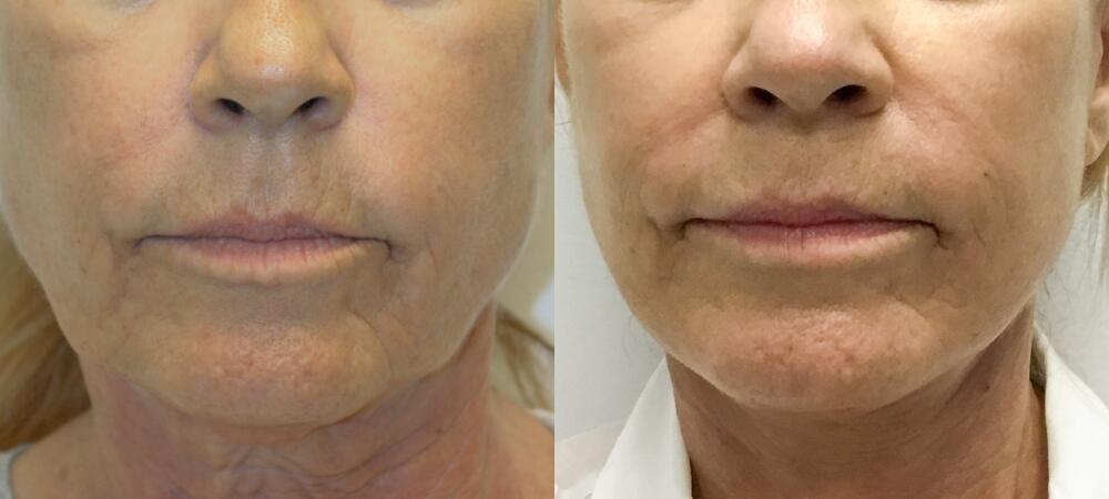 Jose Rodríguez-Feliz, MD neck lift result — Coral Gables, FL