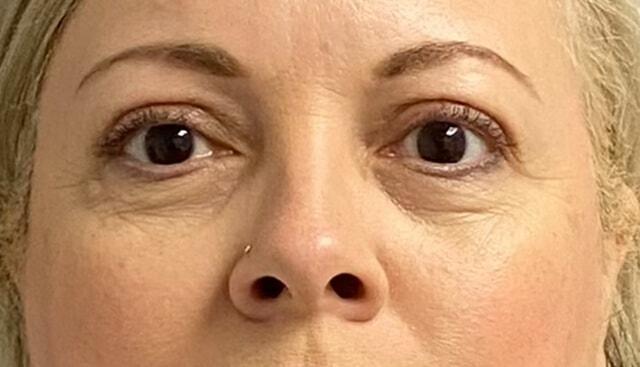 Blepharoplasty after at Jonathan A. Schwitzer, MD Plastic Surgery in Bay Harbor Islands, FL