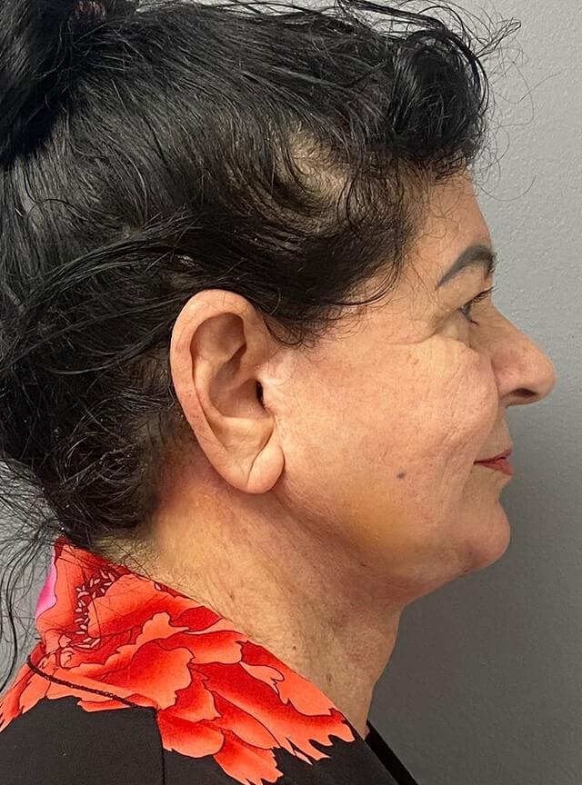 Facelift after at Jonathan A. Schwitzer, MD Plastic Surgery in Bay Harbor Islands, FL
