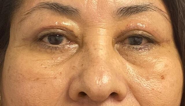Blepharoplasty after at Jonathan A. Schwitzer, MD Plastic Surgery in Bay Harbor Islands, FL