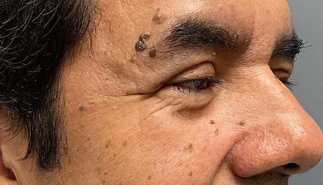 Blepharoplasty after at Jonathan A. Schwitzer, MD Plastic Surgery in Bay Harbor Islands, FL