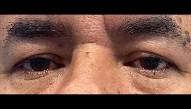 Blepharoplasty before at Jonathan A. Schwitzer, MD Plastic Surgery in Bay Harbor Islands, FL