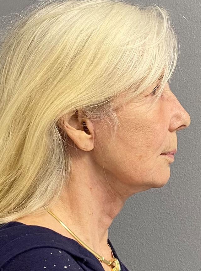 Facelift after at Jonathan A. Schwitzer, MD Plastic Surgery in Bay Harbor Islands, FL