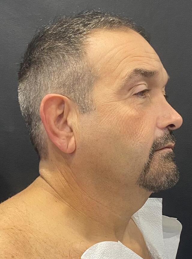 Facelift before at Jonathan A. Schwitzer, MD Plastic Surgery in Bay Harbor Islands, FL