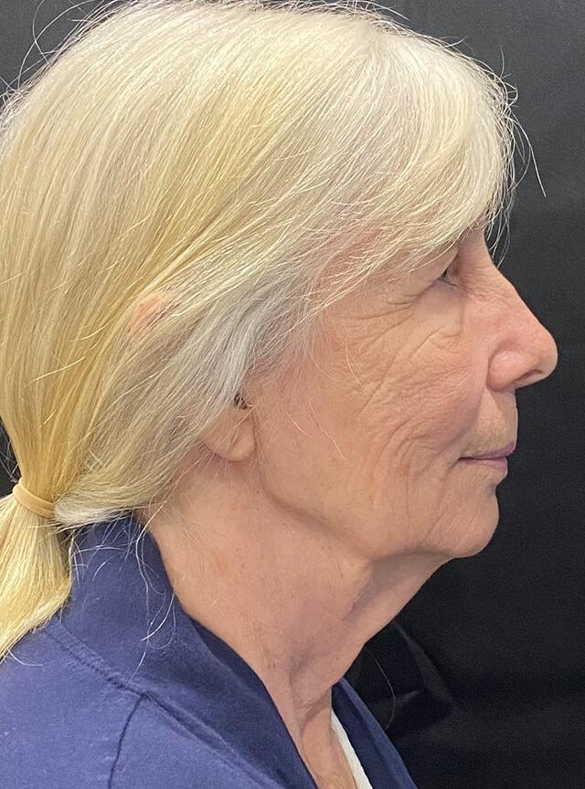 Facelift before at Jonathan A. Schwitzer, MD Plastic Surgery in Bay Harbor Islands, FL