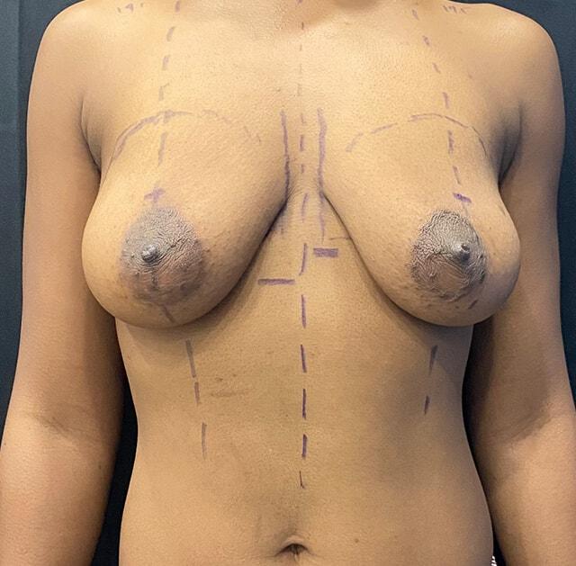 Breast Augmentation before at Jonathan A. Schwitzer, MD Plastic Surgery in Bay Harbor Islands, FL