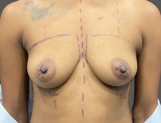 Breast Augmentation before at Jonathan A. Schwitzer, MD Plastic Surgery in Bay Harbor Islands, FL
