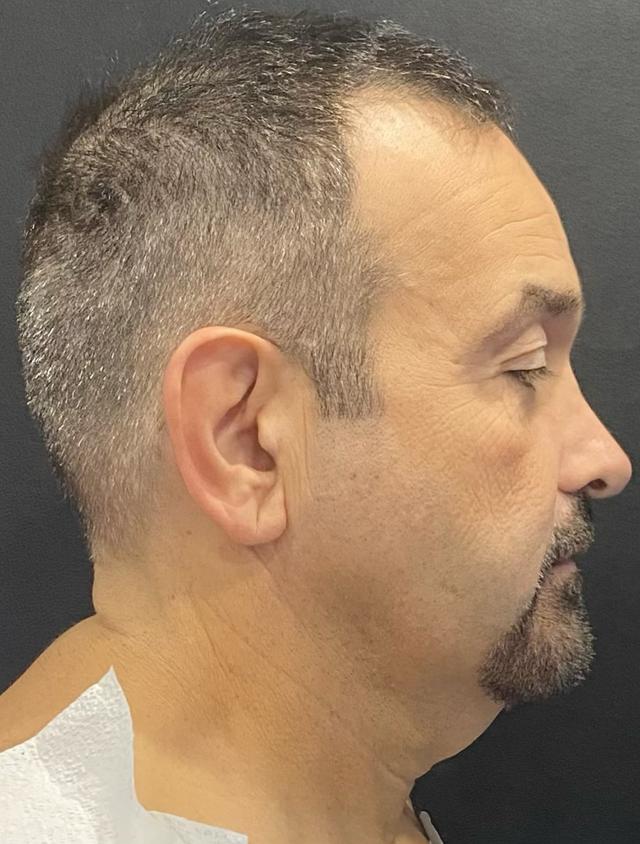 Facelift before at Jonathan A. Schwitzer, MD Plastic Surgery in Bay Harbor Islands, FL