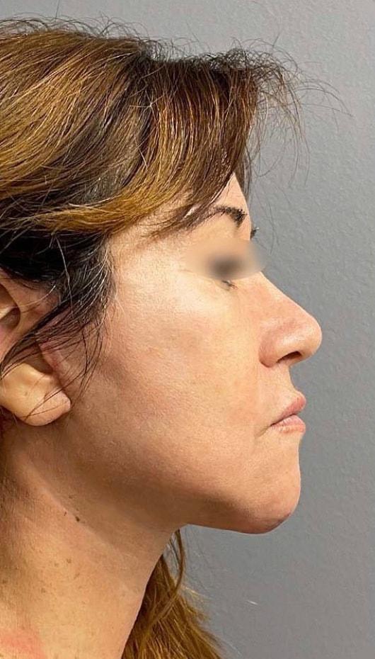 Facelift after at Jonathan A. Schwitzer, MD Plastic Surgery in Bay Harbor Islands, FL