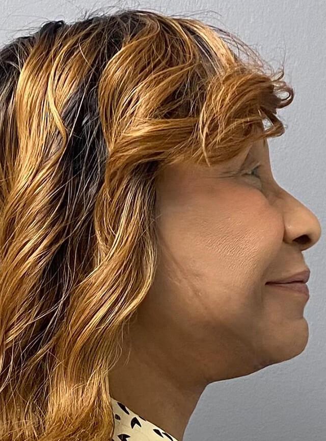 Facelift after at Jonathan A. Schwitzer, MD Plastic Surgery in Bay Harbor Islands, FL