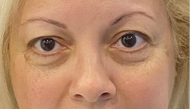 Blepharoplasty before at Jonathan A. Schwitzer, MD Plastic Surgery in Bay Harbor Islands, FL