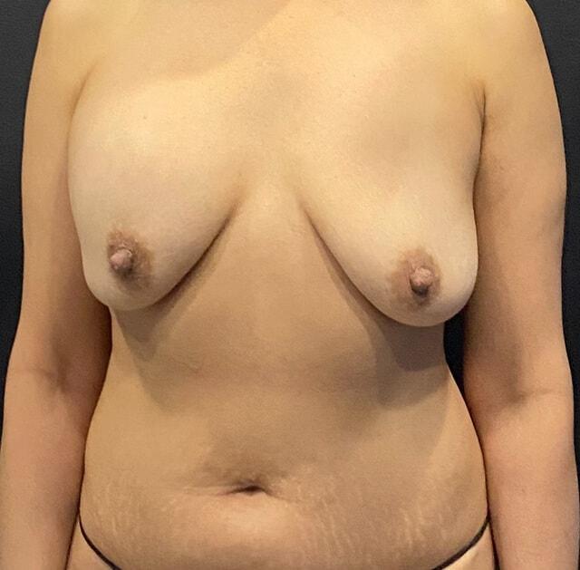Breast Reduction before at Jonathan A. Schwitzer, MD Plastic Surgery in Bay Harbor Islands, FL