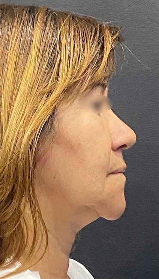 Facelift before at Jonathan A. Schwitzer, MD Plastic Surgery in Bay Harbor Islands, FL