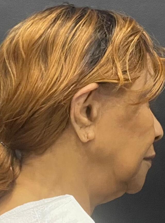 Facelift before at Jonathan A. Schwitzer, MD Plastic Surgery in Bay Harbor Islands, FL