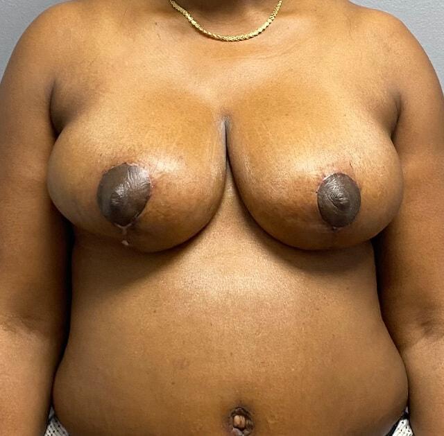 Breast Reduction after at Jonathan A. Schwitzer, MD Plastic Surgery in Bay Harbor Islands, FL