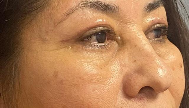 Blepharoplasty after at Jonathan A. Schwitzer, MD Plastic Surgery in Bay Harbor Islands, FL