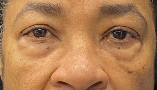 Blepharoplasty before at Jonathan A. Schwitzer, MD Plastic Surgery in Bay Harbor Islands, FL