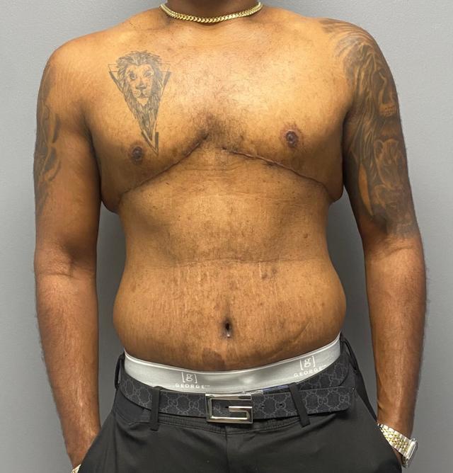 Mini Tummy Tuck after at Jonathan A. Schwitzer, MD Plastic Surgery in Bay Harbor Islands, FL