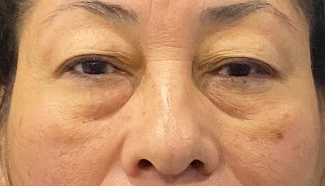 Blepharoplasty before at Jonathan A. Schwitzer, MD Plastic Surgery in Bay Harbor Islands, FL
