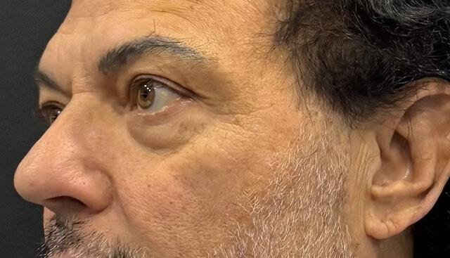 Blepharoplasty before at Jonathan A. Schwitzer, MD Plastic Surgery in Bay Harbor Islands, FL