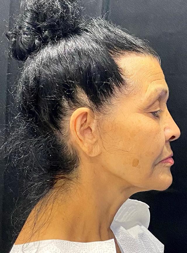 Facelift before at Jonathan A. Schwitzer, MD Plastic Surgery in Bay Harbor Islands, FL