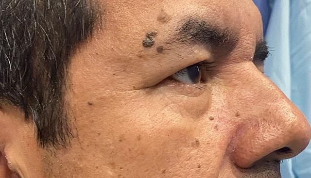 Blepharoplasty before at Jonathan A. Schwitzer, MD Plastic Surgery in Bay Harbor Islands, FL