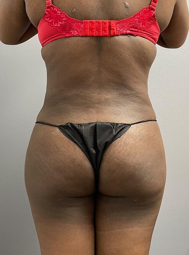 Brazilian Butt Lift after at Jonathan A. Schwitzer, MD Plastic Surgery in Bay Harbor Islands, FL