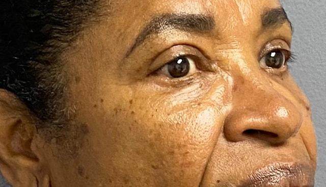 Blepharoplasty after at Jonathan A. Schwitzer, MD Plastic Surgery in Bay Harbor Islands, FL