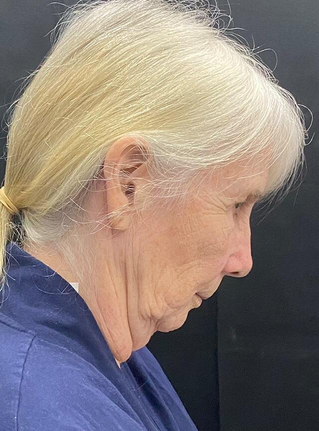 Facelift before at Jonathan A. Schwitzer, MD Plastic Surgery in Bay Harbor Islands, FL