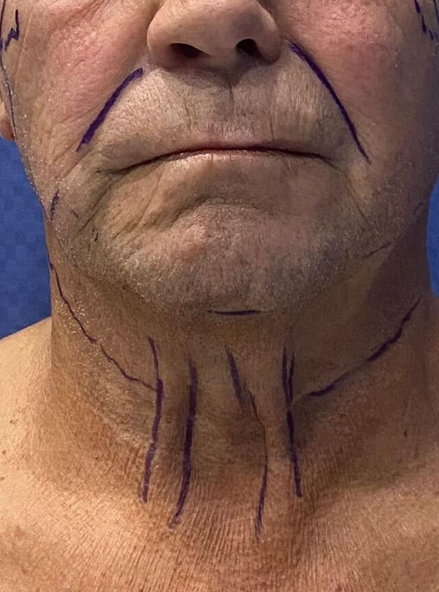 Facelift before at Jonathan A. Schwitzer, MD Plastic Surgery in Bay Harbor Islands, FL