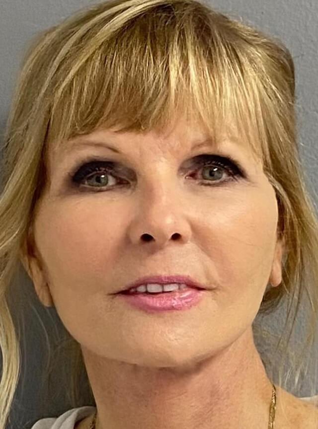 Facelift after at Jonathan A. Schwitzer, MD Plastic Surgery in Bay Harbor Islands, FL