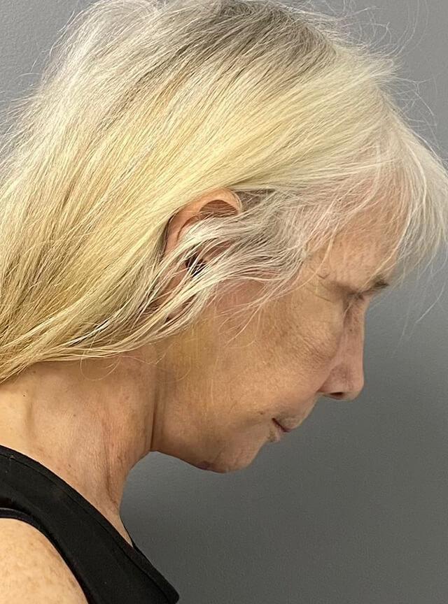 Facelift after at Jonathan A. Schwitzer, MD Plastic Surgery in Bay Harbor Islands, FL