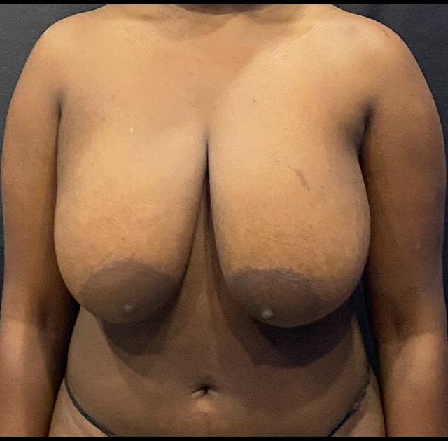 Breast Reduction before at Jonathan A. Schwitzer, MD Plastic Surgery in Bay Harbor Islands, FL