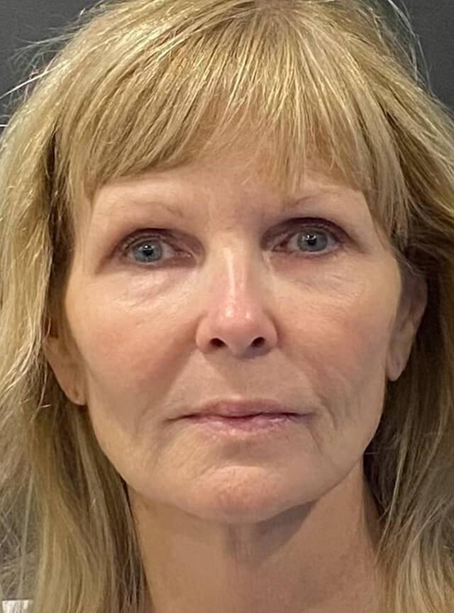Facelift before at Jonathan A. Schwitzer, MD Plastic Surgery in Bay Harbor Islands, FL