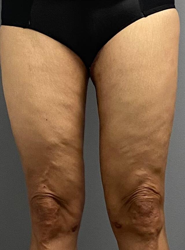Thigh Lift after at Jonathan A. Schwitzer, MD Plastic Surgery in Bay Harbor Islands, FL