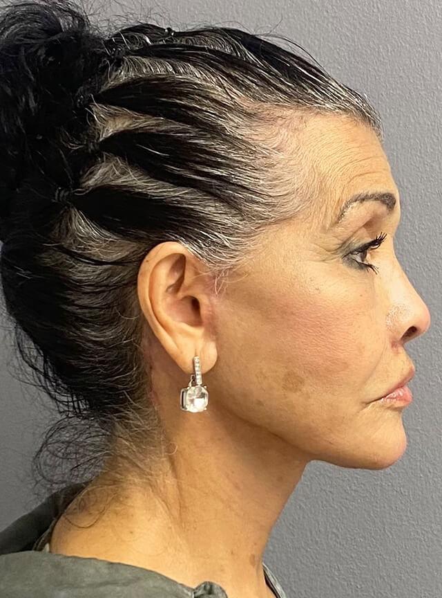 Facelift after at Jonathan A. Schwitzer, MD Plastic Surgery in Bay Harbor Islands, FL