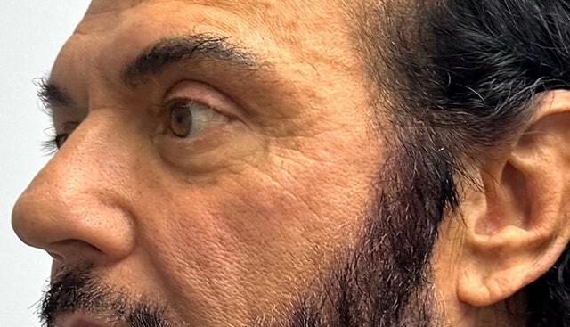 Blepharoplasty after at Jonathan A. Schwitzer, MD Plastic Surgery in Bay Harbor Islands, FL