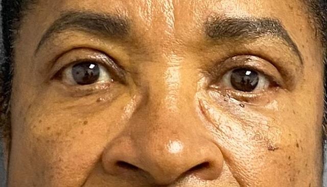 Blepharoplasty after at Jonathan A. Schwitzer, MD Plastic Surgery in Bay Harbor Islands, FL