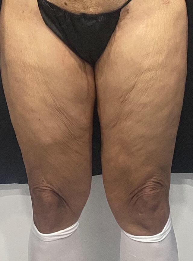 Thigh Lift before at Jonathan A. Schwitzer, MD Plastic Surgery in Bay Harbor Islands, FL