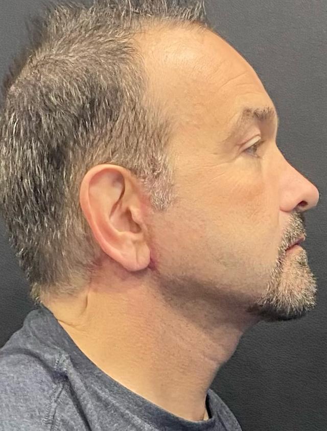 Facelift after at Jonathan A. Schwitzer, MD Plastic Surgery in Bay Harbor Islands, FL