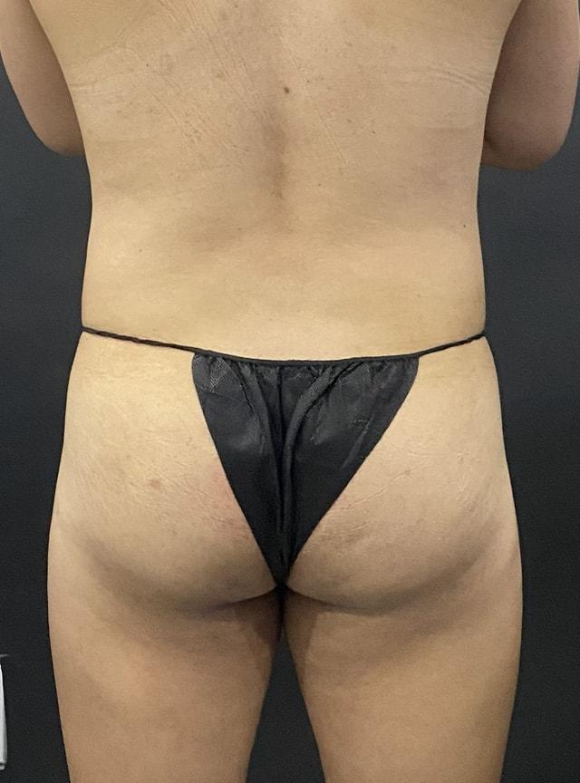 Brazilian Butt Lift before at Jonathan A. Schwitzer, MD Plastic Surgery in Bay Harbor Islands, FL