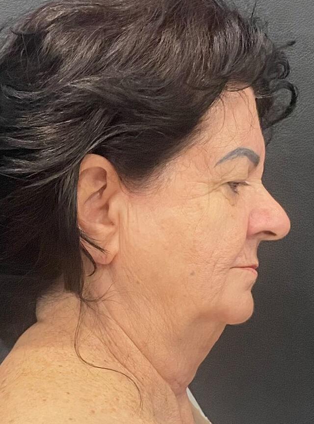 Facelift before at Jonathan A. Schwitzer, MD Plastic Surgery in Bay Harbor Islands, FL